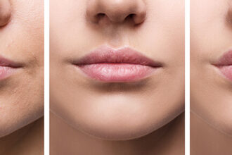 Lip Flip Before and After: Your Ultimate Guide to Subtle Enhancements