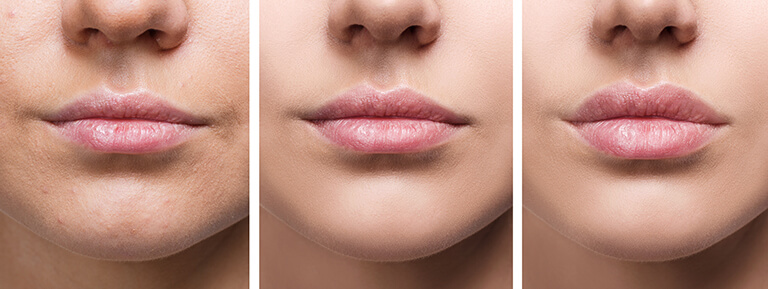 Lip Flip Before and After: Your Ultimate Guide to Subtle Enhancements