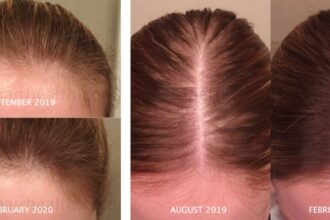 nutrafol side effects