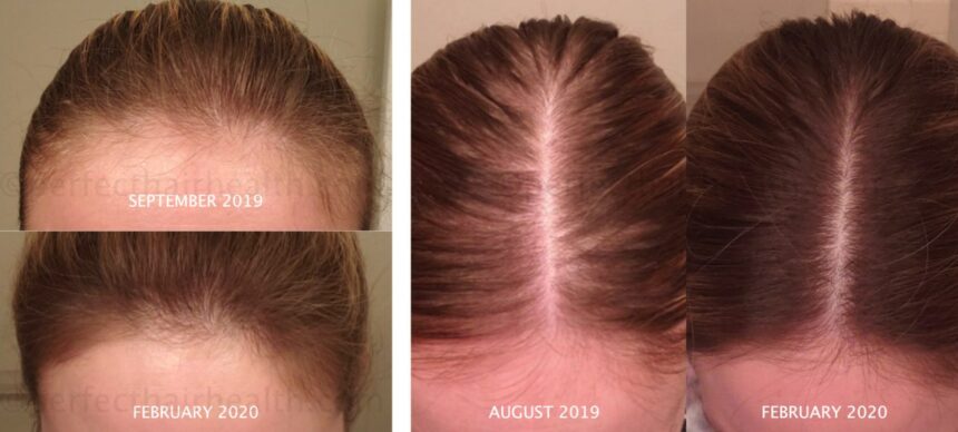 nutrafol side effects