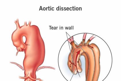Aortic Dissection