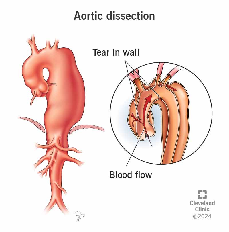 Aortic Dissection