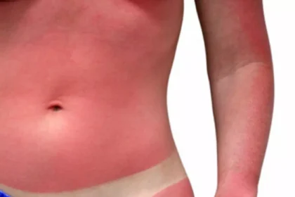 Sun Poisoning