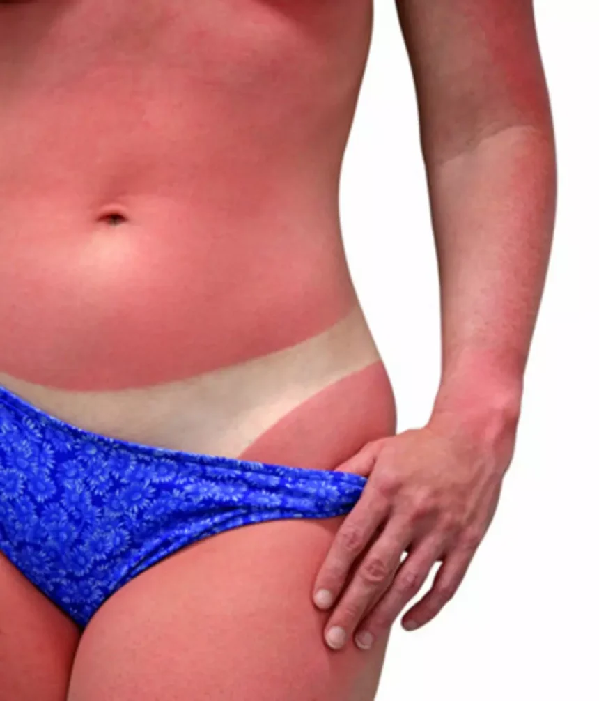 Sun Poisoning